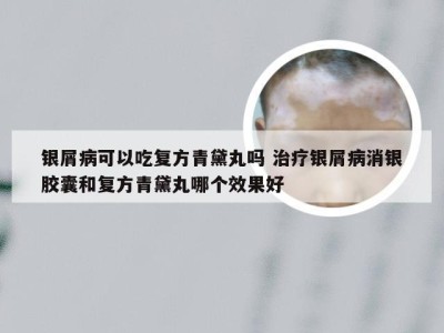 银屑病可以吃复方青黛丸吗 治疗银屑病消银胶囊和复方青黛丸哪个效果好