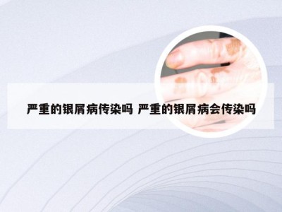 严重的银屑病传染吗 严重的银屑病会传染吗