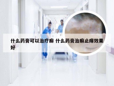 什么药膏可以治疗癣 什么药膏治癣止痒效果好