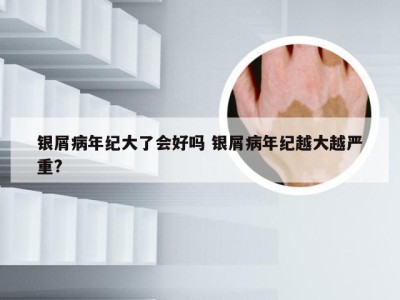 银屑病年纪大了会好吗 银屑病年纪越大越严重?