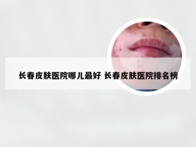 长春皮肤医院哪儿最好 长春皮肤医院排名榜