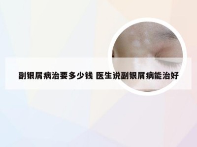 副银屑病治要多少钱 医生说副银屑病能治好