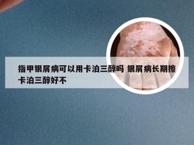 指甲银屑病可以用卡泊三醇吗 银屑病长期擦卡泊三醇好不