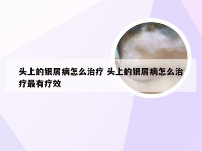 头上的银屑病怎么治疗 头上的银屑病怎么治疗最有疗效