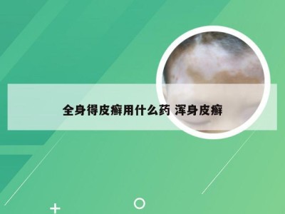 全身得皮癣用什么药 浑身皮癣