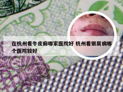 在杭州看牛皮癣哪家医院好 杭州看银屑病哪个医院较好