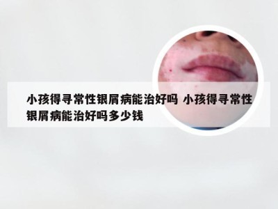 小孩得寻常性银屑病能治好吗 小孩得寻常性银屑病能治好吗多少钱