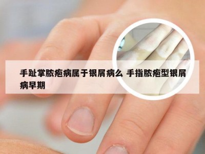 手趾掌脓疱病属于银屑病么 手指脓疱型银屑病早期