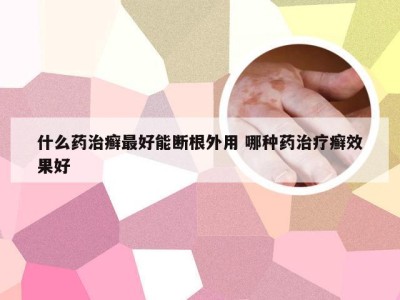 什么药治癣最好能断根外用 哪种药治疗癣效果好