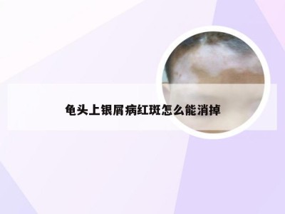 龟头上银屑病红斑怎么能消掉