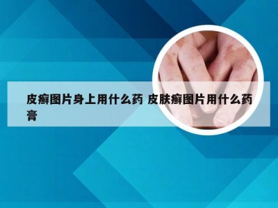 皮癣图片身上用什么药 皮肤癣图片用什么药膏