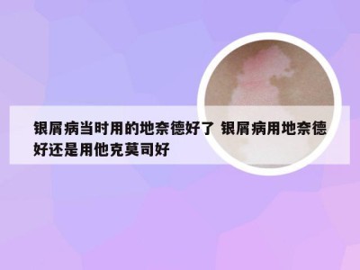 银屑病当时用的地奈德好了 银屑病用地奈德好还是用他克莫司好