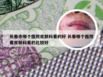 长春市哪个医院皮肤科看的好 长春哪个医院看皮肤科看的比较好