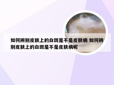 如何辨别皮肤上的白斑是不是皮肤病 如何辨别皮肤上的白斑是不是皮肤病呢