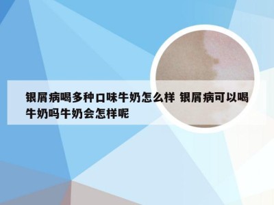 银屑病喝多种口味牛奶怎么样 银屑病可以喝牛奶吗牛奶会怎样呢