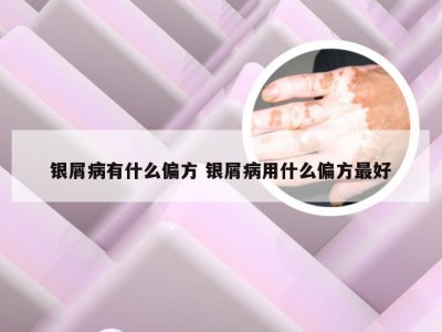 银屑病有什么偏方 银屑病用什么偏方最好