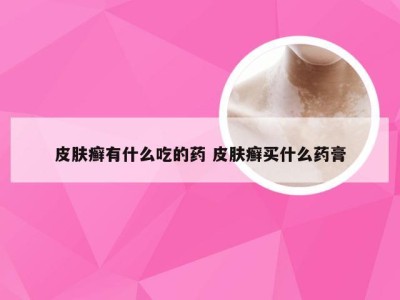 皮肤癣有什么吃的药 皮肤癣买什么药膏