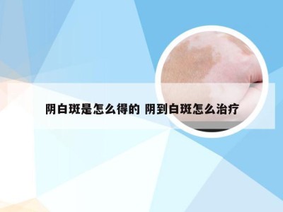 阴白斑是怎么得的 阴到白斑怎么治疗