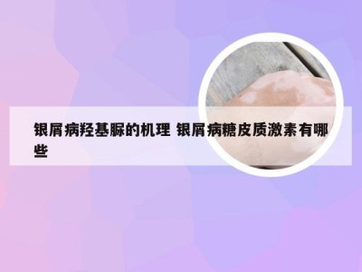 银屑病羟基脲的机理 银屑病糖皮质激素有哪些