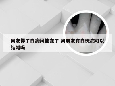 男友得了白癜风他变了 男朋友有白斑病可以结婚吗