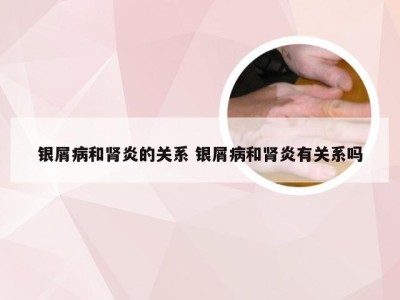 银屑病和肾炎的关系 银屑病和肾炎有关系吗