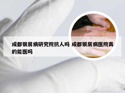 成都银屑病研究院抗人吗 成都银屑病医院真的能医吗