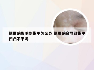 银屑病影响到指甲怎么办 银屑病会导致指甲凹凸不平吗