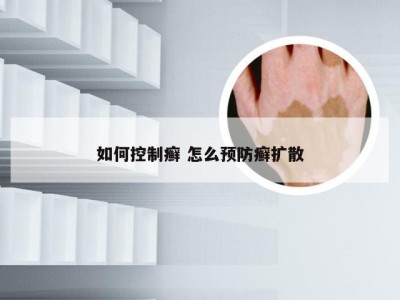 如何控制癣 怎么预防癣扩散