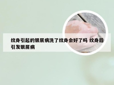 纹身引起的银屑病洗了纹身会好了吗 纹身后引发银屑病