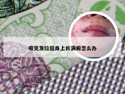 喷完发拉后身上长满癣怎么办