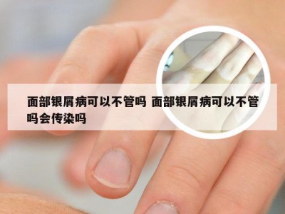 面部银屑病可以不管吗 面部银屑病可以不管吗会传染吗