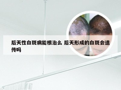 后天性白斑病能根治么 后天形成的白斑会遗传吗