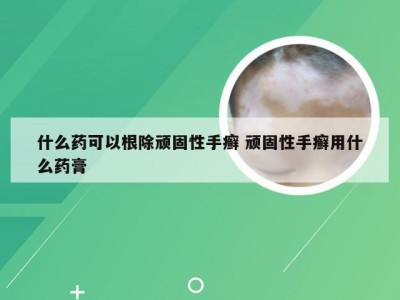 什么药可以根除顽固性手癣 顽固性手癣用什么药膏