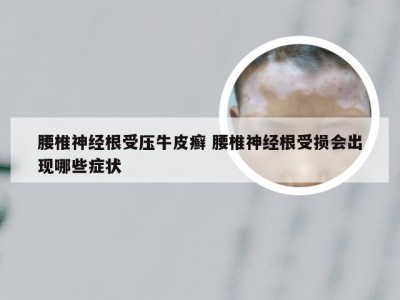 腰椎神经根受压牛皮癣 腰椎神经根受损会出现哪些症状