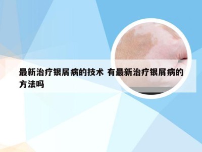 最新治疗银屑病的技术 有最新治疗银屑病的方法吗