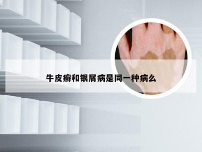 牛皮癣和银屑病是同一种病么