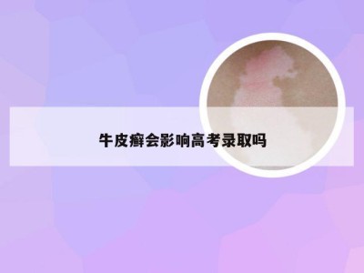 牛皮癣会影响高考录取吗