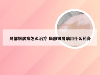 局部银屑病怎么治疗 局部银屑病用什么药膏