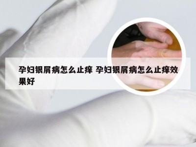 孕妇银屑病怎么止痒 孕妇银屑病怎么止痒效果好