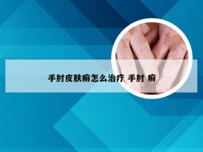 手肘皮肤癣怎么治疗 手肘 癣