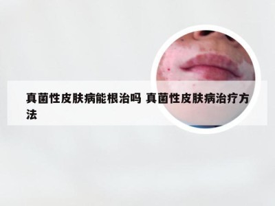 真菌性皮肤病能根治吗 真菌性皮肤病治疗方法