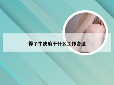 得了牛皮癣干什么工作合适