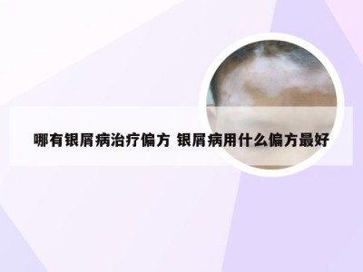 哪有银屑病治疗偏方 银屑病用什么偏方最好