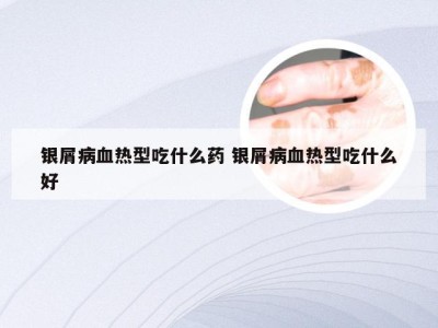 银屑病血热型吃什么药 银屑病血热型吃什么好