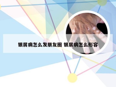 银屑病怎么发朋友圈 银屑病怎么形容