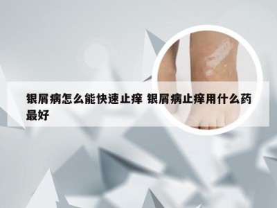 银屑病怎么能快速止痒 银屑病止痒用什么药最好