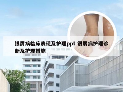 银屑病临床表现及护理ppt 银屑病护理诊断及护理措施