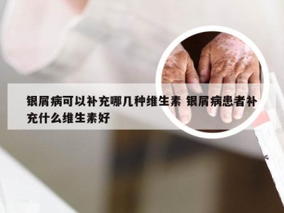 银屑病可以补充哪几种维生素 银屑病患者补充什么维生素好