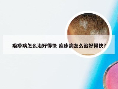 疱疹病怎么治好得快 疱疹病怎么治好得快?