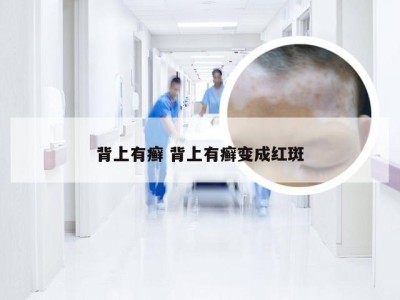 背上有癣 背上有癣变成红斑